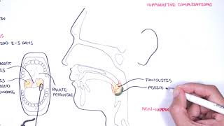 Strep throat streptococcal pharyngitis pathophysciology signs and symptoms diagnosis treatment [upl. by Adler]