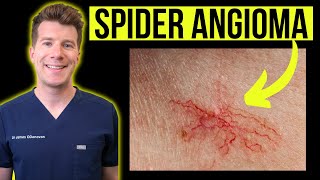 Doctor explains SPIDER ANGIOMA aka spider nevustelangiectasia  Causes photos treatments [upl. by Almond]