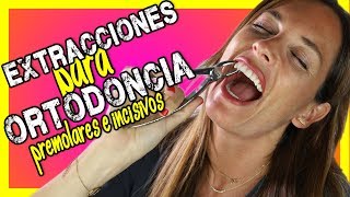 😱 𝐄𝐗𝐓𝐑𝐀𝐂𝐂𝐈𝐎𝐍 𝐝𝐞 𝐏𝐑𝐄𝐌𝐎𝐋𝐀𝐑𝐄𝐒 superiores e inferiores en ORTODONCIAQuitar DIENTES para poner BRACKETS [upl. by Buke373]