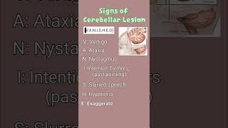 How to Remember the Signs of Cerebellar Disease 🤓🧠 anatomyfacts cerebellum clinicalanatomy [upl. by Emily]