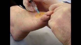 Injection  CSI technique for stump Mortons neuroma [upl. by Refynnej]