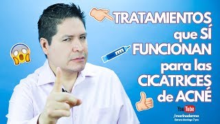 TRATAMIENTOS QUE SÍ FUNCIONAN EN CICATRICES DE ACNÉ [upl. by Ibor411]