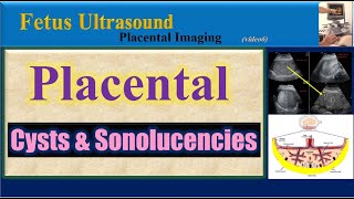 Fetus Ultrasound Placental Cysts amp Sonolucencies [upl. by Wye]