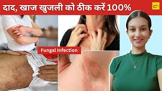 Fungal Infection क्या होता है Causes Symptoms and Treatment  Credihealth [upl. by Roarke]