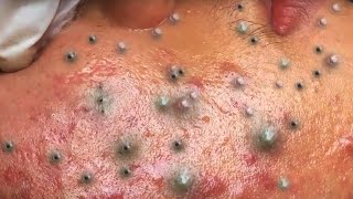 Big Cystic Acne Blackheads Extraction Blackheads amp Milia Whiteheads Removal Pimple Popping  5714 [upl. by London687]