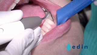 Ultrasoon reinigen bij parodontitis  Edin Dental Academy [upl. by Nemad209]