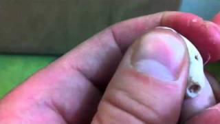 Wart removal on my toe nasty gross disgusting disturbing [upl. by Lewse]