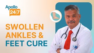 Swollen Ankles amp Feet Causes and Cure  Dr S K Sahoo  Apollo 247 [upl. by Samella]