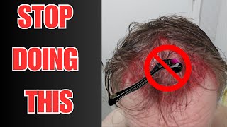 Stop Microneedling WATCH NOW [upl. by Ferrand]