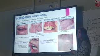 estomatitis aftosa recurrente [upl. by Asehr65]