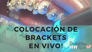 Colocación de Brackets en VIVO  Putting on Braces  LIVE [upl. by Clem492]