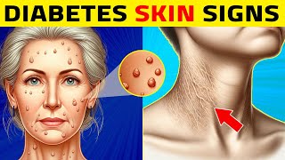 8 Diabetes Skin Signs You Shouldnt Ignore [upl. by Naivatco]