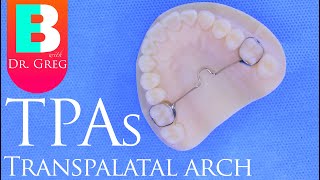 Braces TPA Transpalatal Arch [upl. by Salman]