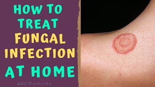 HOW TO TREAT SKIN FUNGAL INFECTION INFECTION AT HOME TINEA RINGWORM REMEDIES HOW TO CURE [upl. by Eiluj]