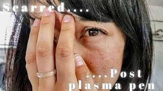 7 weeks post Plasma Pen Treatment Regrets [upl. by Ahsennek]