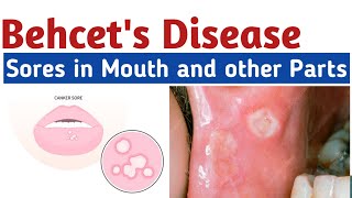 Behcets Disease  Symptoms Causes And Mouth sores treatment  how to get rid of mouth blisters [upl. by Ybab]