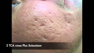 TCA CROSS for acne scars [upl. by Ervin]