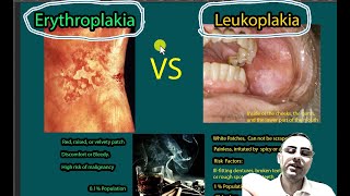 Erythroplakia Vs Leukoplakia Symptoms causes risk of malignancies [upl. by Ahsatan557]