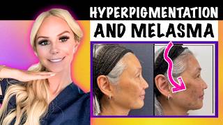 GLOWING SKIN  Hyperpigmentation vs Melasma  How to Treat Dark Spots and Sunspots [upl. by Enileme463]