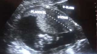 ULTRASOUND 2nd Trimester normal pregnancy [upl. by Suzzy]