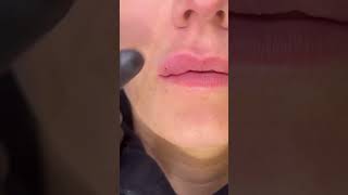 Dissolving Using Hyalase Dermal Fillers Lip Fillers [upl. by Sena]