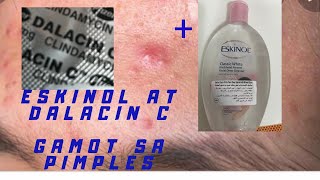 cheap and effective  acne solution [upl. by Cherey]