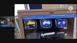 PulmoVista 500 Guided Recruitment of Dorsal Atelectasis Using APRV  Prone Position [upl. by Naujak329]