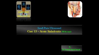 Ultrasound Case 13  Acute Sialadenitis Web case [upl. by Nevaj]