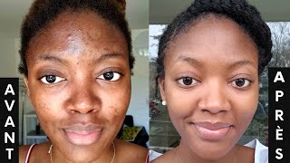 L ACNÉ COMMENT s en DÉBARRASSER 3 PRODUITS contre les boutons et les tâches🔥  SKINCARE ROUTINE💦 [upl. by Notrub]