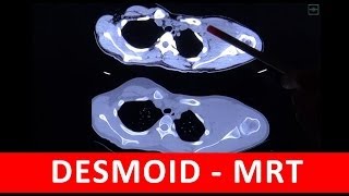 Desmoid  CT und MRT Analyse  by Radiologie TV [upl. by Hareemas]