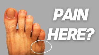 How to Fix a Tailors Bunion Bunionette [upl. by Lluj]