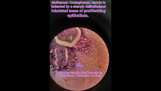 Molluscum contagiosumhistologyskininfectionspathologymedical [upl. by Ragucci]