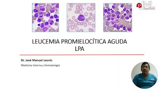 LEUCEMIA PROMIELOCÍTICA AGUDA APRENDIZAJE BASADO EN CASO CLÍNICO PARTE 1 [upl. by Aramad]