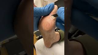 Watch Podiatrist Debride Wart After Salicylic Acid Treatment  Hard Skin Removal with Docpods [upl. by Eceinert148]