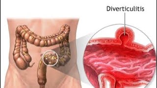 Diverticulitis  Causes Types Symptoms and Treatment [upl. by Sanoj]