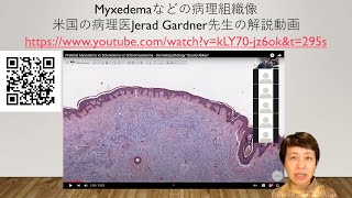 Myxedemaなどの病理組織像の解説 [upl. by Killarney546]