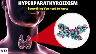 Hyperparathyroidism – Types Causes Signs and Symptoms Diagnosis amp Treatment [upl. by Anirehtak]