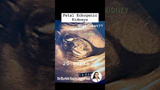 Fetal echogenic kidneys  Dr Surbhi Gupta Aggarwal  Consultant Radiologist [upl. by Enileoj415]