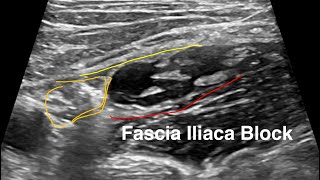 POCUS Case Fascia Iliaca Nerve Block [upl. by Leopold]