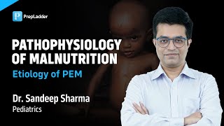 Pathophysiology of Malnutrition Etiology of PEM by Dr Sandeep Sharma [upl. by Anilemrac]