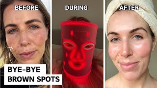 How I got rid of my melasma  cosmelan peel review [upl. by Hgierb]