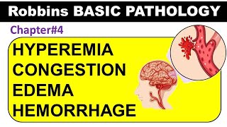 Chp4 Part1 Robbins Basic Patho  Hyperemia  Congestion  Edema  Hemorrhage  General Pathology [upl. by Ainecey916]