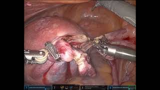 Straight forward Robotic TLH lysis of bladder adhesions [upl. by Pelage]