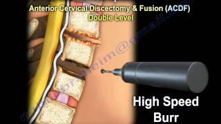 Cervical Spine Decompression And Fusion   Everything You Need To Know  Dr Nabil Ebraheim [upl. by Arramahs]