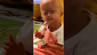 eliseeloa lindas izouno sindromerara progeria 050mp4 [upl. by Geoffry]