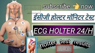 ecg holter monitor test  holter test results  holter monitor 24 hoursheart holter testviral [upl. by Aniaz]