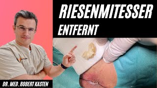 RIESENKOMEDO in der Leiste entfernt Hautarzt kann es kaum fassen Mitesser pimple giant comedone [upl. by Dix614]