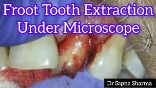 Front tooth got extracted UNDER A MICROSCOPE  Front Tooth Removal Procedure  Teeth Pulled Out [upl. by Cort]