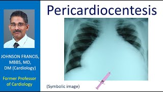 Pericardiocentesis [upl. by Jandy]