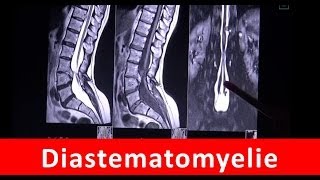 Diastematomyelie  Magnetresonanztomographie  by Radiologie TV [upl. by Ydorb]